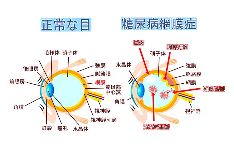 糖尿病網膜症のイメージ画像